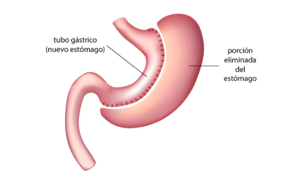 Cirugía Bariátrica Hospital Cádiz, Clínica Digestiva