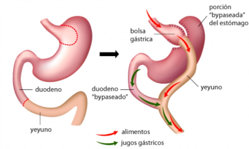 Cirugía Bariátrica Hospital Cádiz, Clínica Digestiva